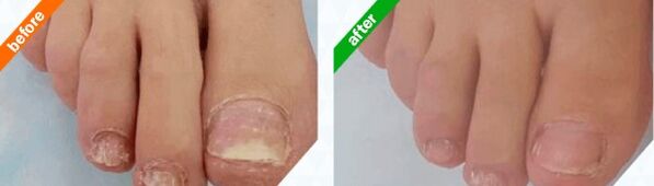 Fotos antes y después de usar el producto, experiencia de uso de Myceril