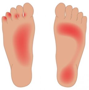 La propagación del hongo a lo largo de la superficie de los pies. 