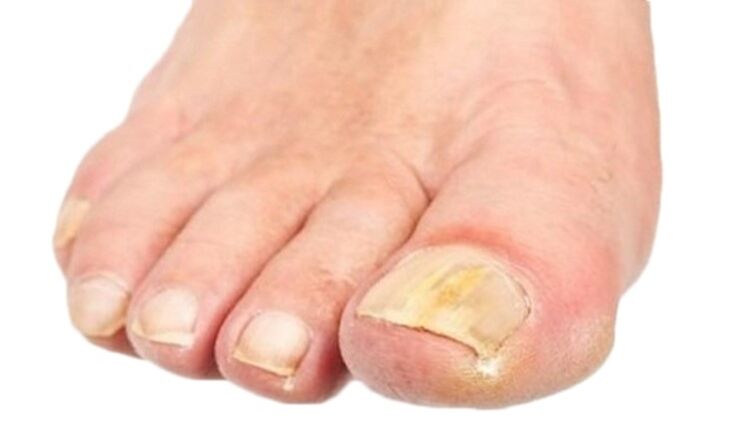 Micosis que destruye las uñas de los pies