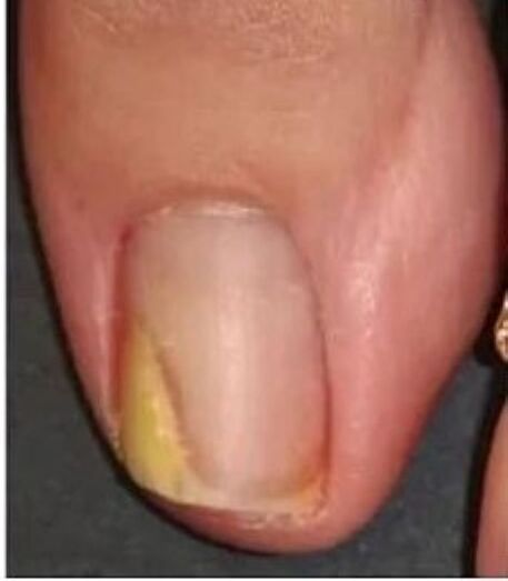 uña del pie con hongos antes del tratamiento