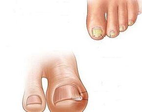 progresión de hongos en las uñas de los pies