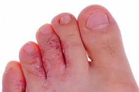 hongo del dedo del pie