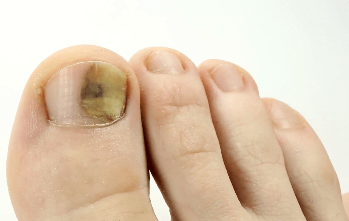 infección por hongos en las uñas