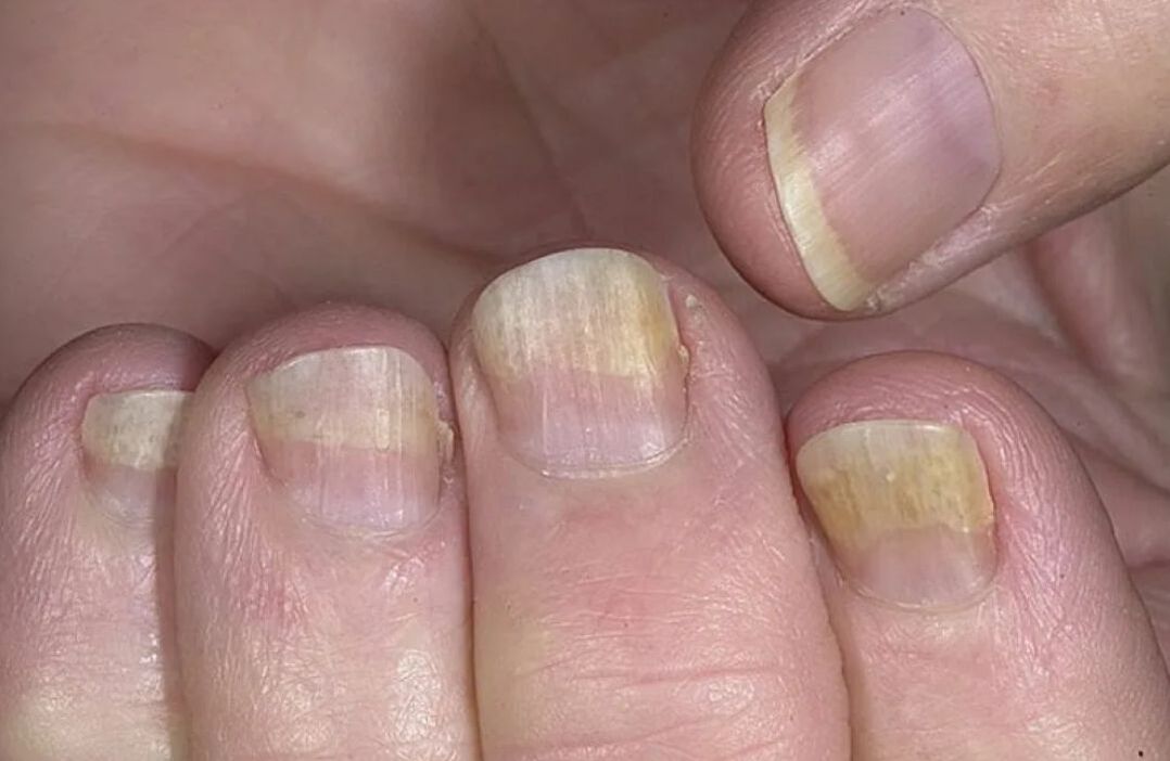 Síntomas de hongos en las uñas de los pies