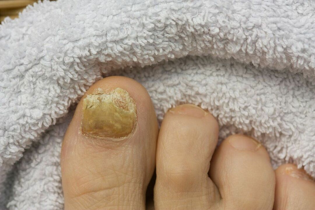 causas de hongos en las uñas de los pies
