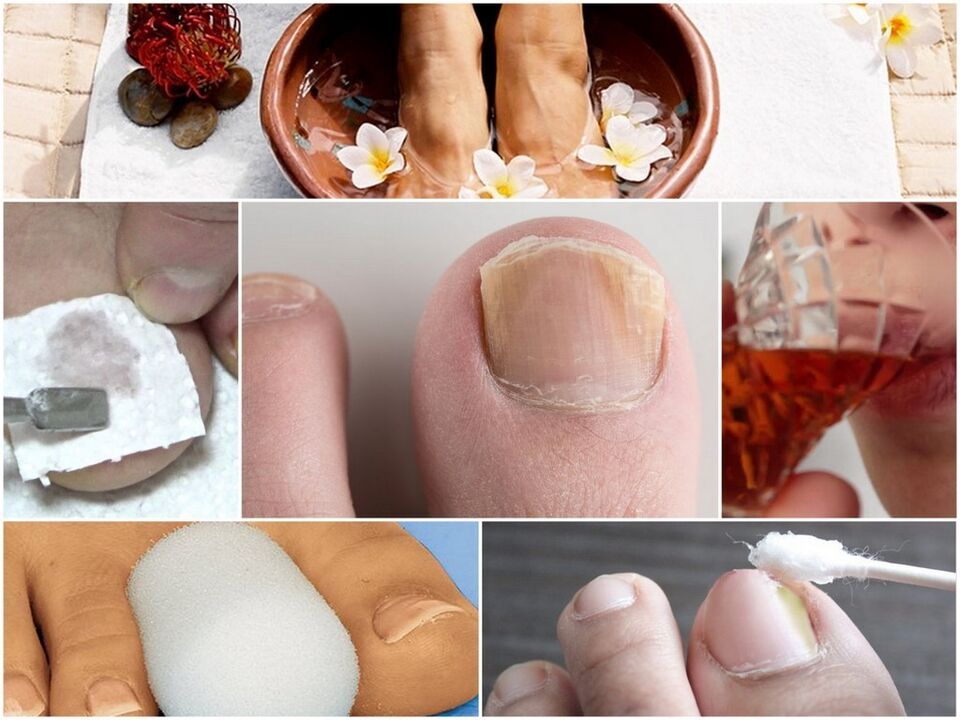 tratamiento natural para hongos en las uñas