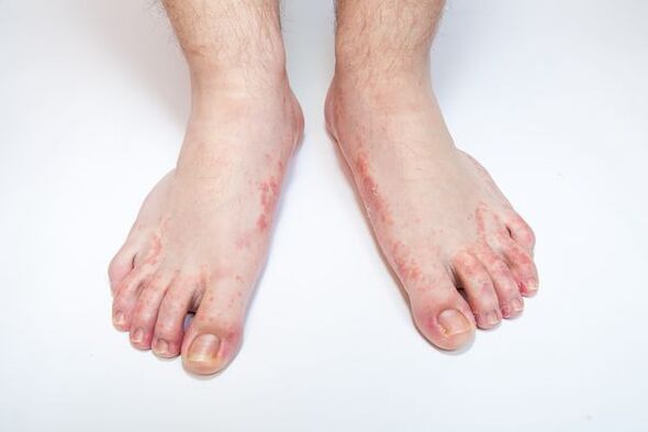 hongos en la piel de los pies