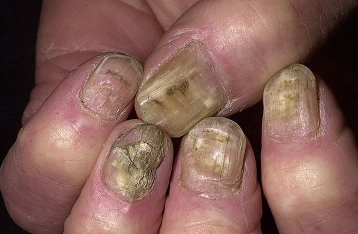 Deformación, separación y desmoronamiento de las uñas debido a hongos. 