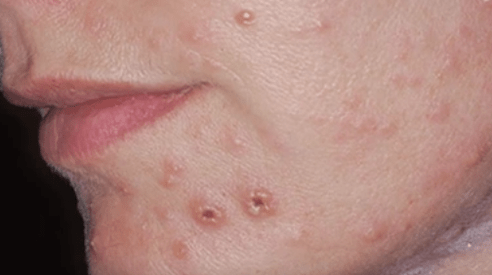 Infección por hongos de la piel de la cara. 