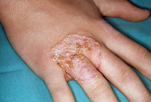 Manchas rojas en forma de collar en la piel de las manos debido a micosis. 
