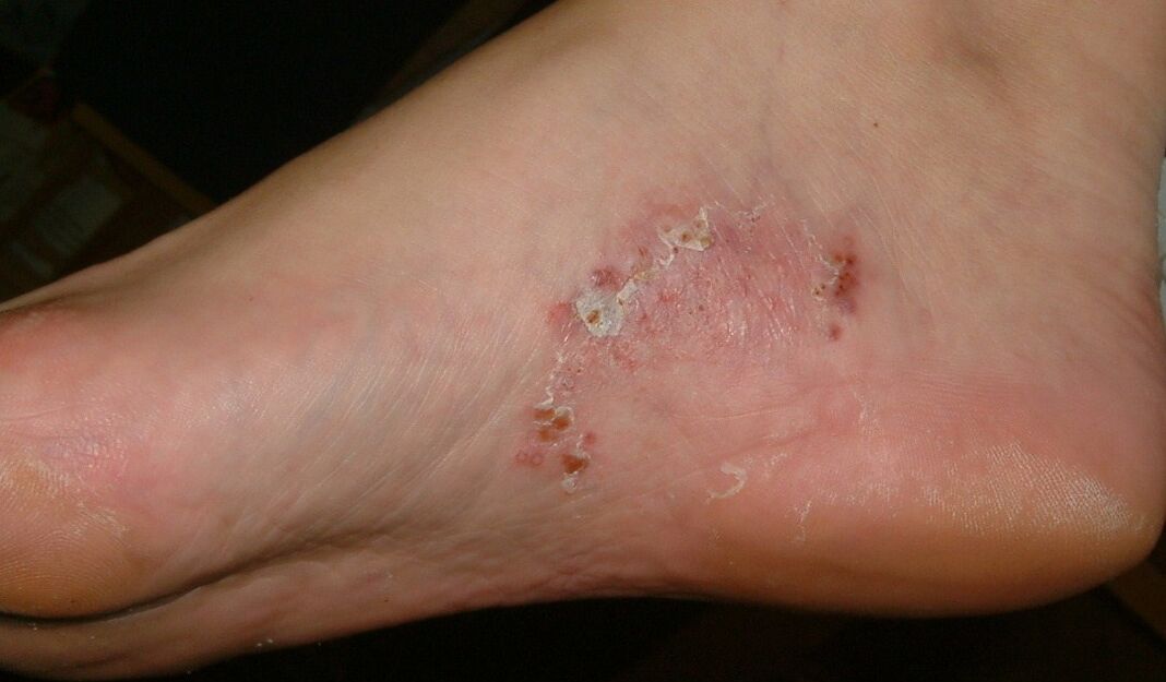 Manifestaciones de una infección por hongos en el pie. 